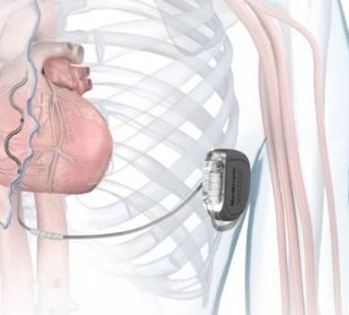 W1TR04 美敦力植入式心臟再同步治療起搏器
