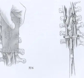 LP-2 美敦力脊柱內(nèi)固定系統(tǒng)-椎板固定板系統(tǒng)