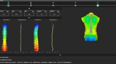 GD-AIS 脊柱側彎輔助測量軟件成電金盤