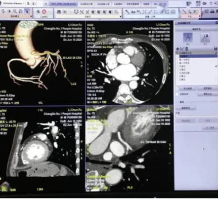 inferread cta coronary  ct造影圖像血管狹窄輔助評估軟件