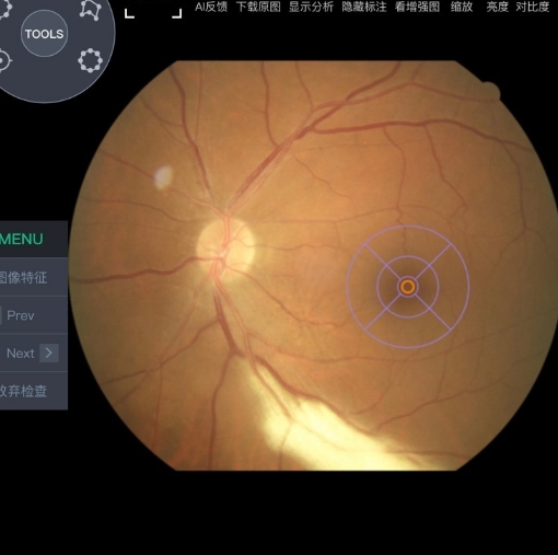 MCS（云服務(wù)器版） 眼底病變眼底圖像輔助診斷軟件